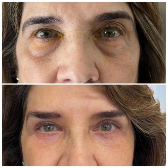 Método Olhar 4K vale a pena e é melhor o curso de procedimentos estéticos para região periocular 2025 para iniciantes